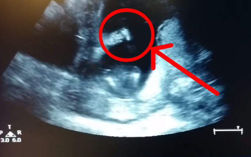Did This Unborn Baby Clap Her Hands in the Womb?