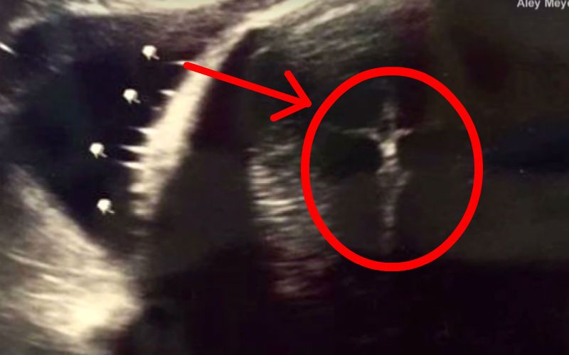 Is There a Crucifix on This Baby's Ultrasound?